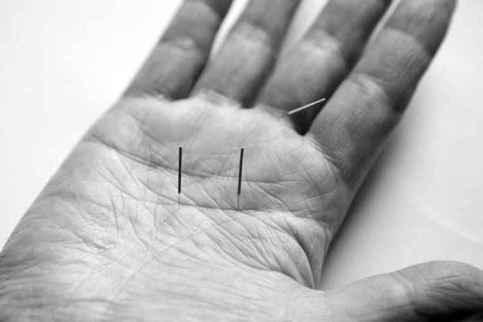 acupuncture